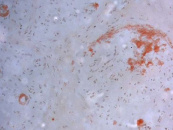 Paraffin-Einbettung/Kongorot-Färbung bei Amyloidose: Amyloid-Ablagerungen um mehrere endoneurale Gefäße, in einem Faszikel perineural und fleckförmig endoneural