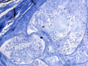 Semidünn-Schnitt bei Amyloidose (Toluidinblau); Kunststoff-/Epon-Einbettung. Ablagerung hyalinen Materials um endoneurale Gefäße, in einem Faszikel fleckförmig endoneural