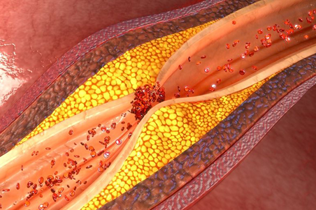 Coronary artery plaque rupture and thrombus formation. Image: 7activestudio/fotolia.com