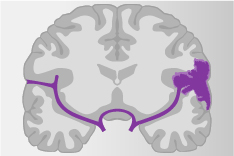 Graphische Abbildung des Gehirns, an einer Seite ein geplatzes Blutgefäß und das davon ausgelaufene Blut ist lila markiert.