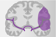 Graphische Abbildung des Gehirns, mit einer Verstopfung eines Blutgefäßes an einer Seite, und um dieser Gefäß herum ist die Problemzone mit lila Farbe markiert